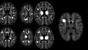What Are Bright Spots in Brain MRI and What Do White Dots Mean?