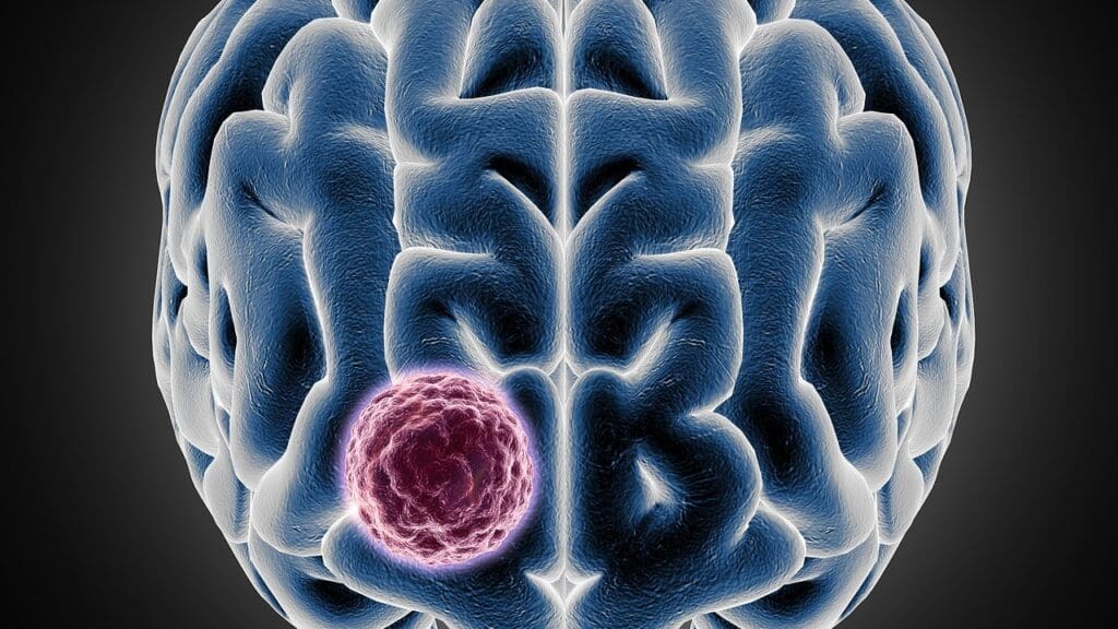 Causes of Brain Lesions Causes of Brain Lesions