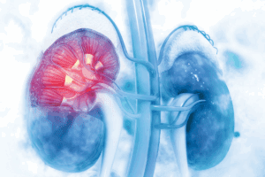 7 Key Facts About Renal renal ablation procedure for Kidney Cancer: What You Need to Know