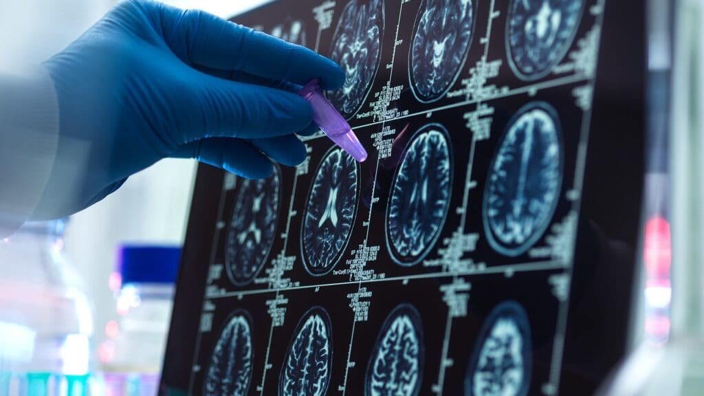 cerebral cyst symptoms cerebral cyst symptoms