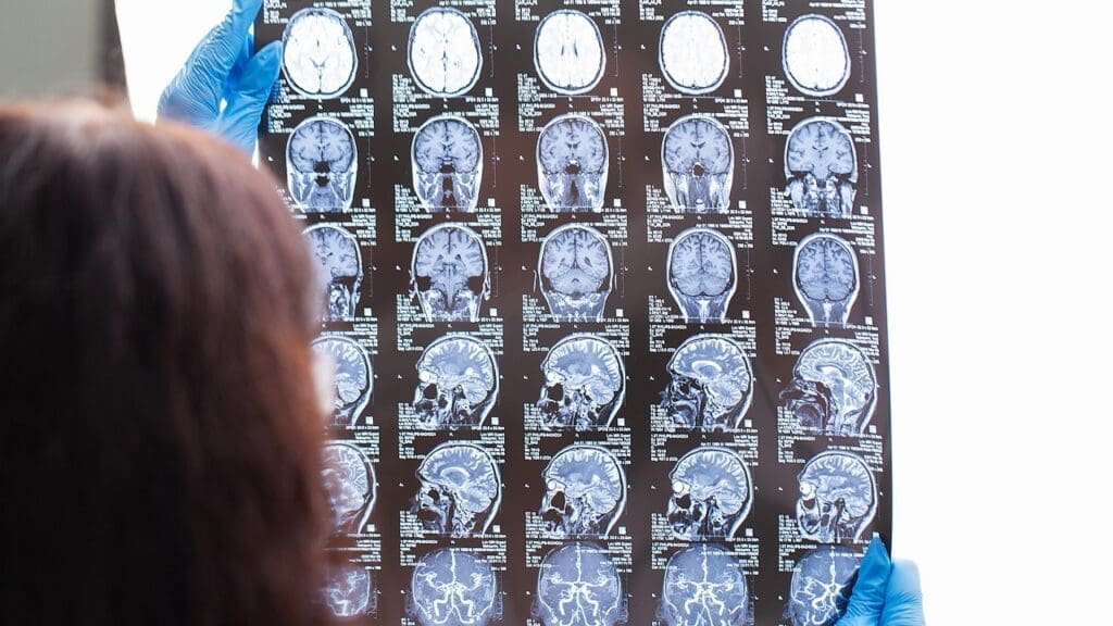 13 Common Symptoms and Key Facts About MRI-Detected Brain Cysts 1 13 Common Symptoms and Key Facts About MRI-Detected Brain Cysts