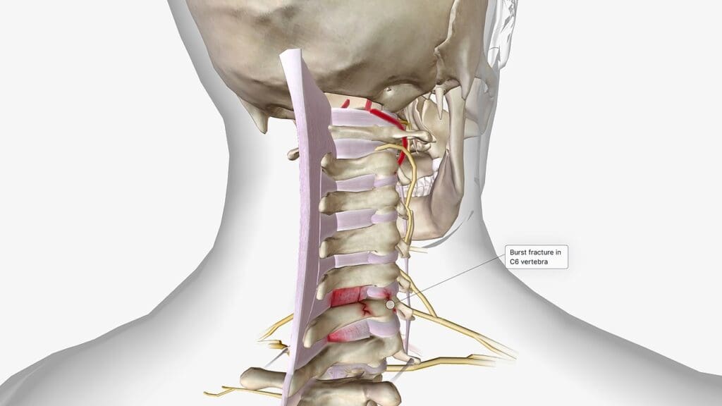 ACDF spine surgery