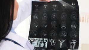 Brain Cyst: 7 Key Symptoms and Facts You Should Know