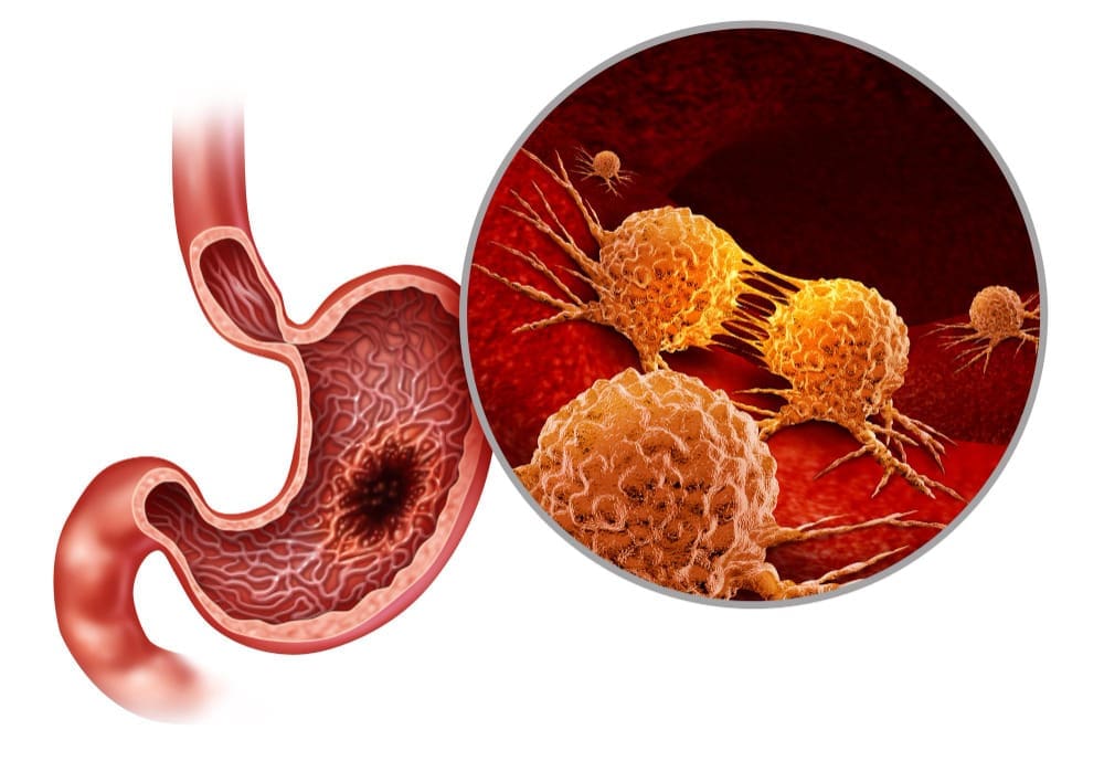 Can Benign Tumors Become Cancerous? Understanding Malignant Tumor Risks and Meanings