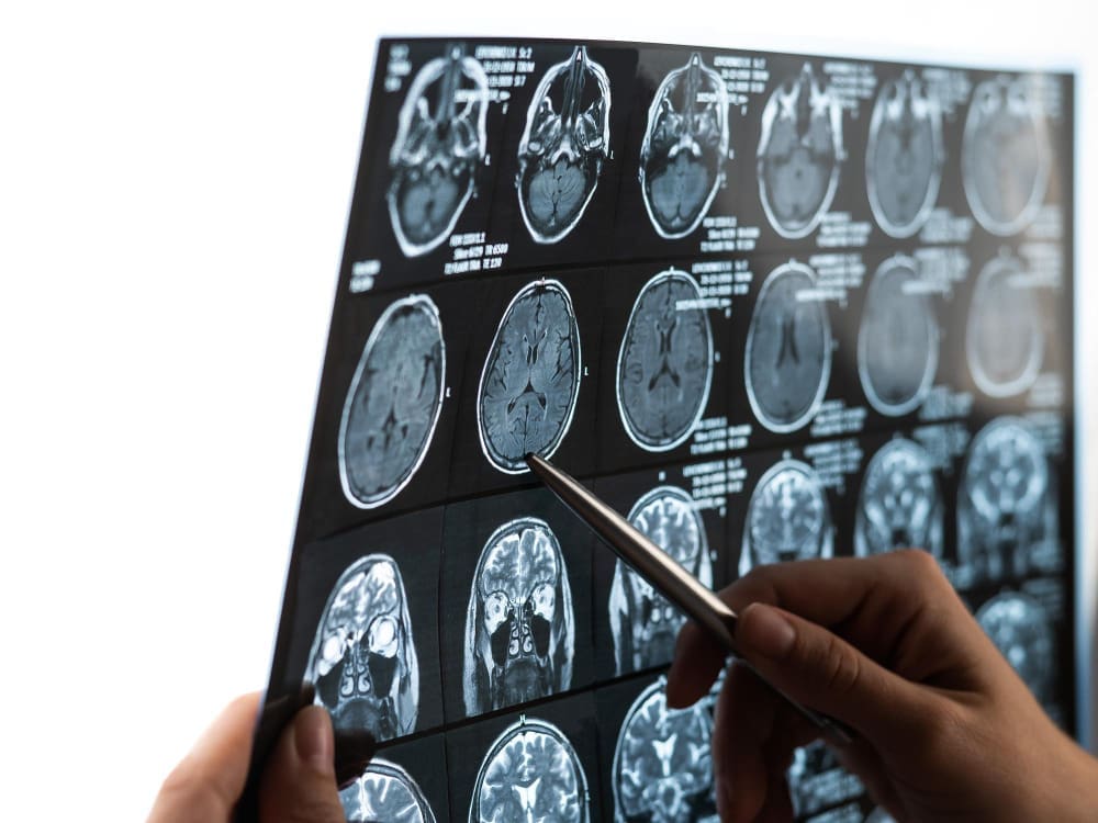 Grade 1 Meningioma Life Expectancy: 7 Key Facts to Know