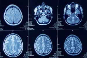 Meningioma Survival Rate: Key Prognosis and Surgery Success Facts