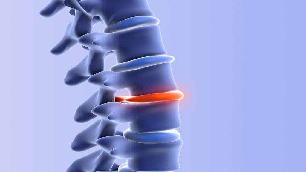 bulging vs slipped disc