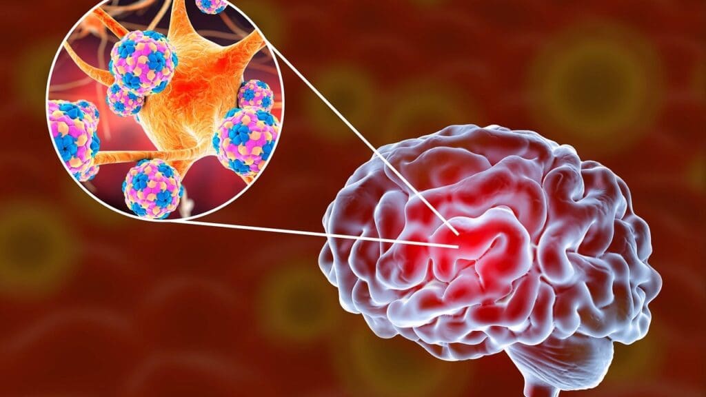 hydrocephalus treatment