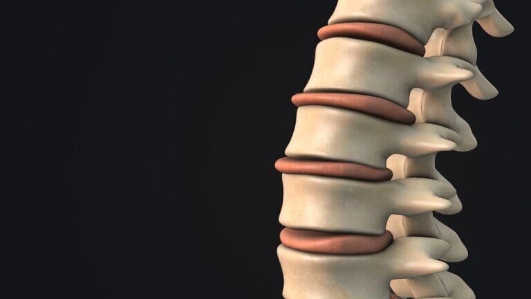 What Is the Difference Between a Bulging Disc and a Slipped Disc?