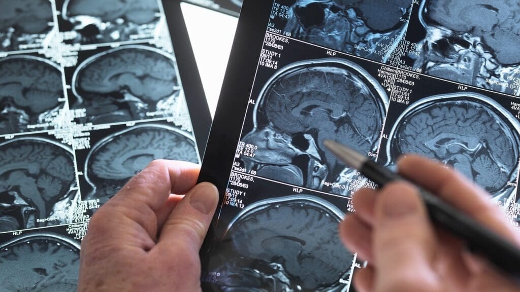 brain cancer decline