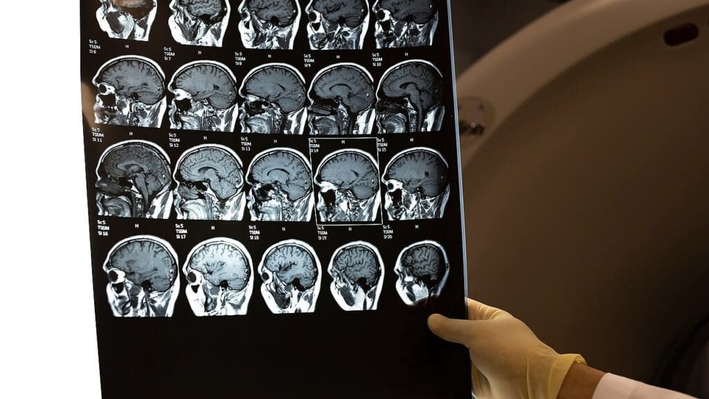 brain tumor classification