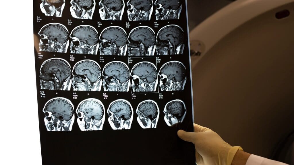 brain cancer survival rate