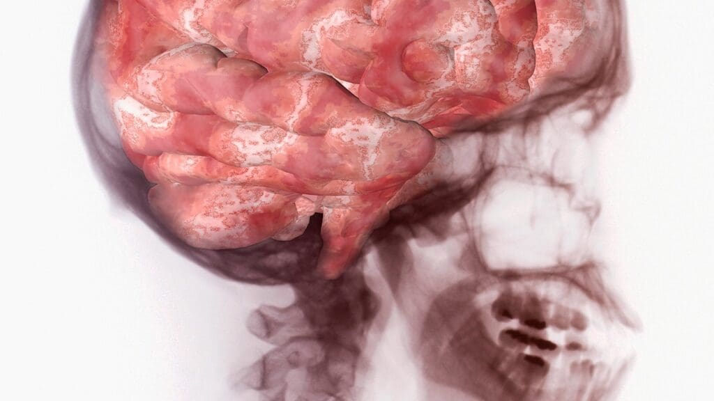 brain tumor progression