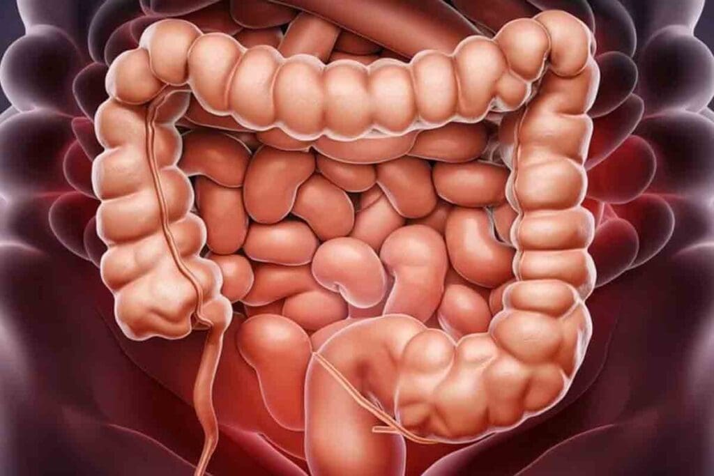 Colon Adhesions: 7 Critical Facts on Bowel Obstruction