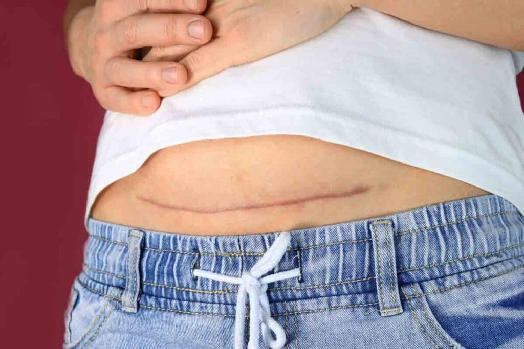 Adhesion Removal: How to Manage This Painful Problem