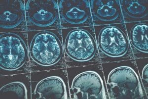 7 Key Facts About Grade 3 Brain Tumor and Its Stages