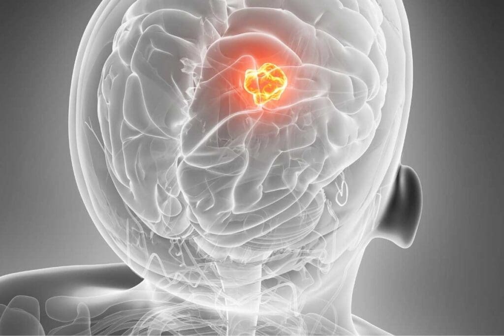 7 Key Facts About Grade 3 Brain Tumor and Its Stages