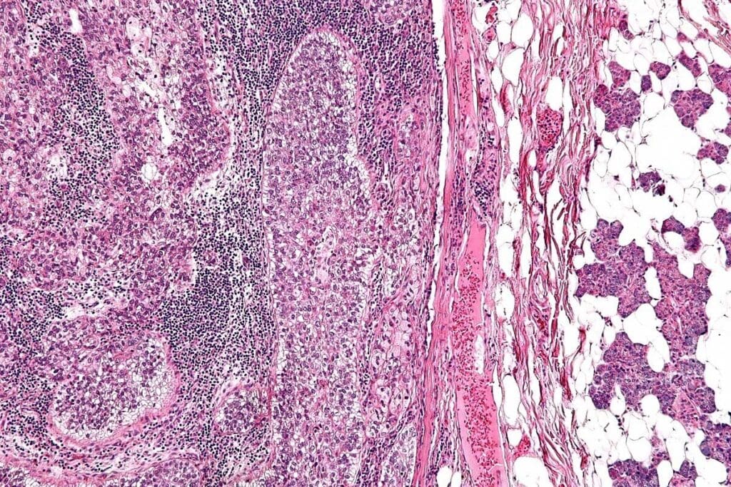 Alveolar Rhabdomyosarcoma: 7 Key Facts