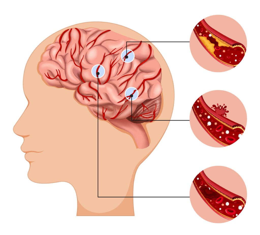 brain clots blood clots in brain survival rate