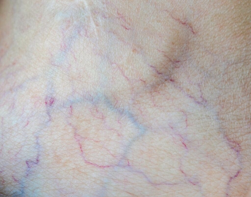 A close-up view of an arteriovenous malformation (AVM) on the skin A close-up view of an arteriovenous malformation (AVM) on the skin