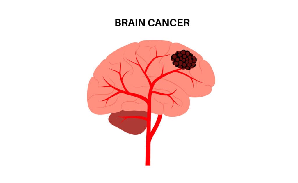 brain tumor brain tumor