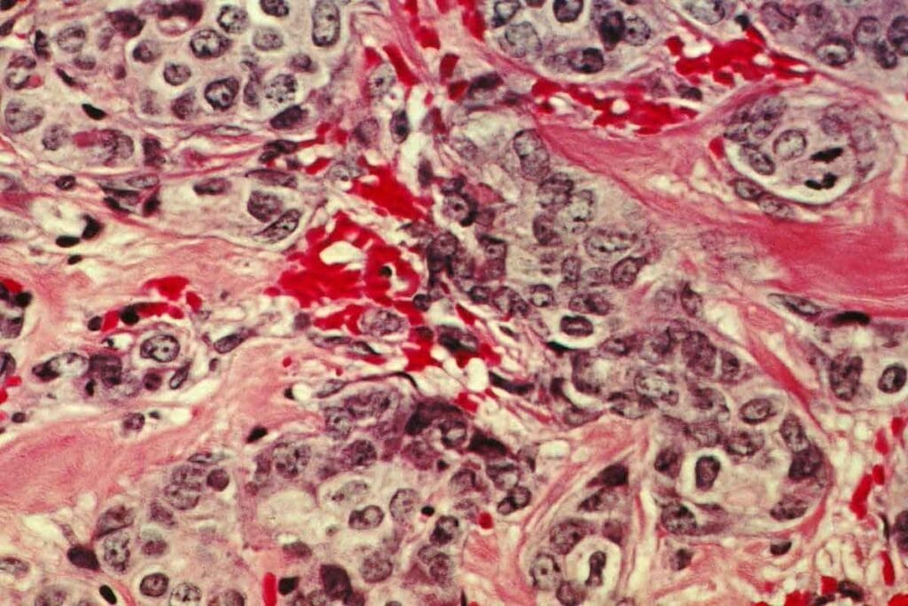 secondary polycythemia is cancer – Causes & Facts