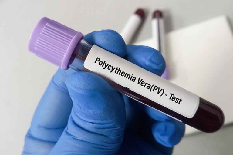polycythaemia diagnosis – 7 Key Tests Explained