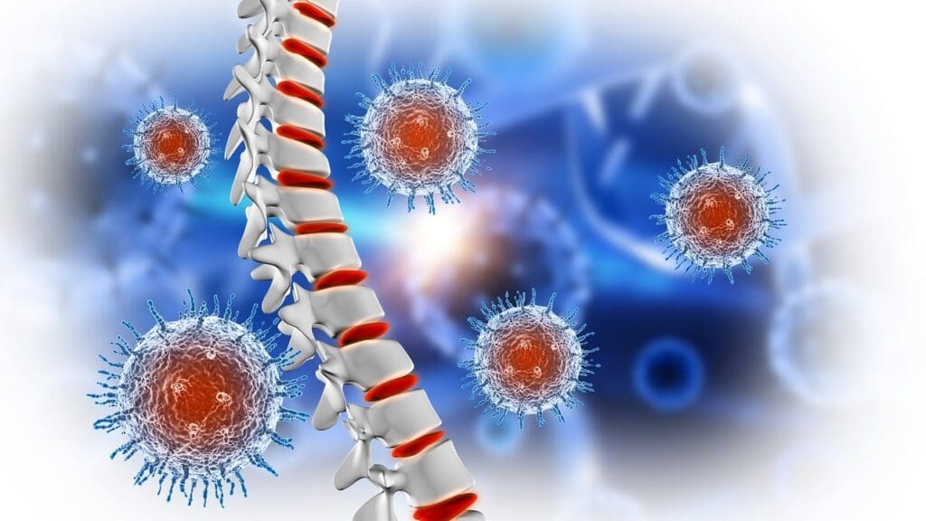 What Is Spinal Metastatic Disease What Is Spinal Metastatic Disease