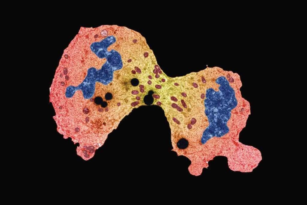 Ewing Sarcoma Cancer in Adults: Causes & Symptoms