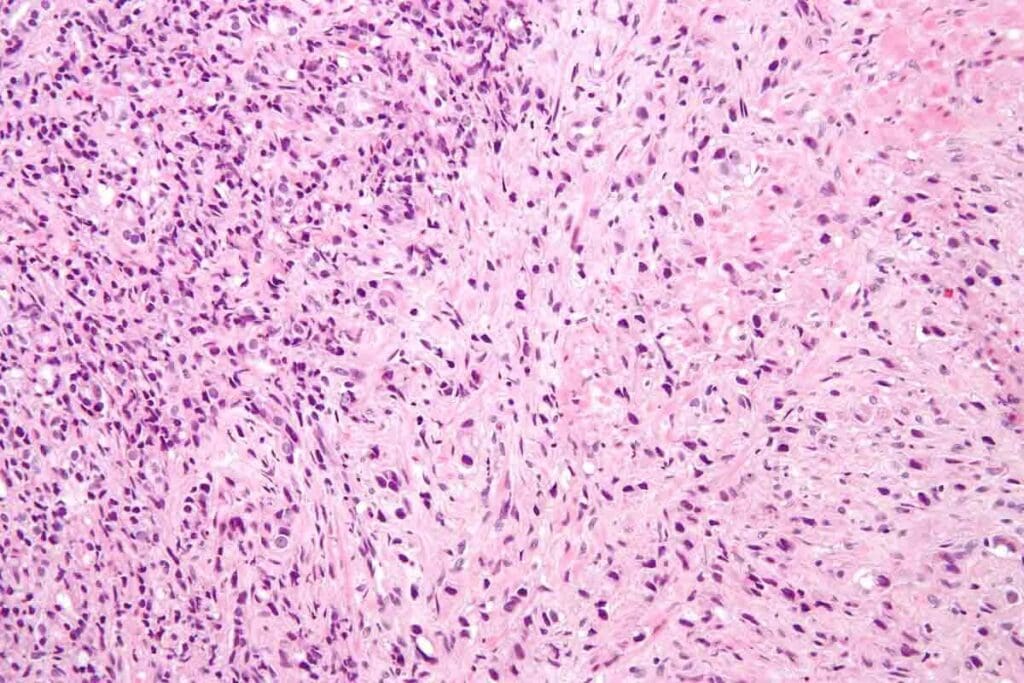 soft tissue sarcoma in leg — Early Signs and Appearance 1 soft tissue sarcoma in leg — Early Signs and Appearance