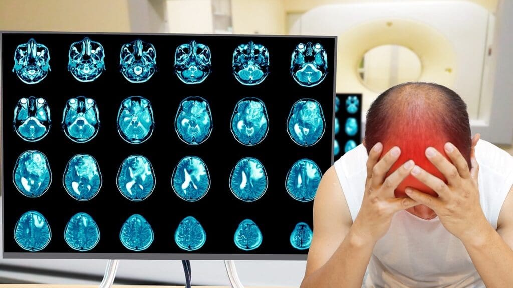 Acute Disseminated Encephalomyelitis Symptoms Acute Disseminated Encephalomyelitis Symptoms