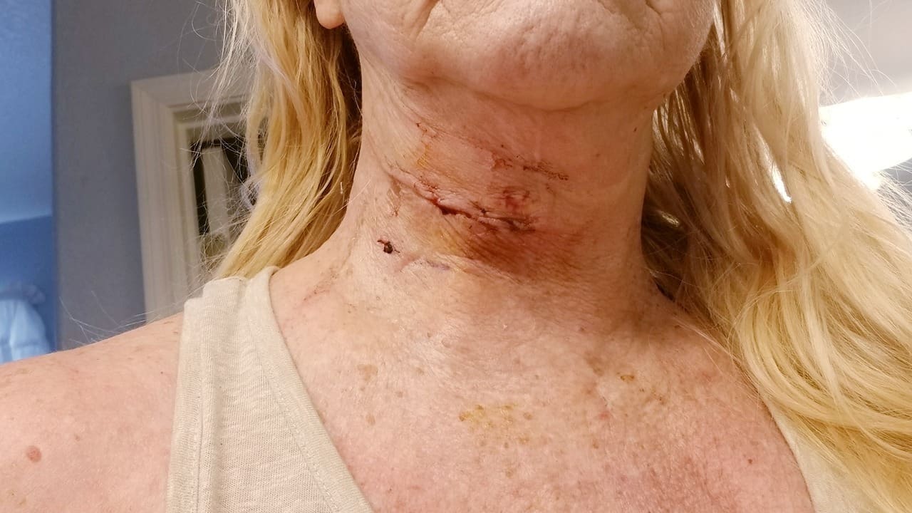 7 Key Facts About Scars from Anterior Cervical Discectomy and Fusion