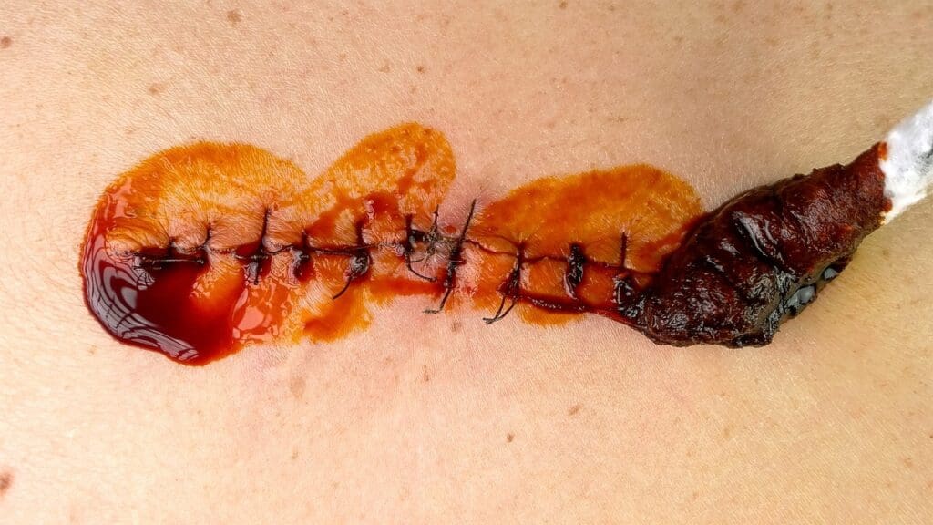 acdf surgery scar