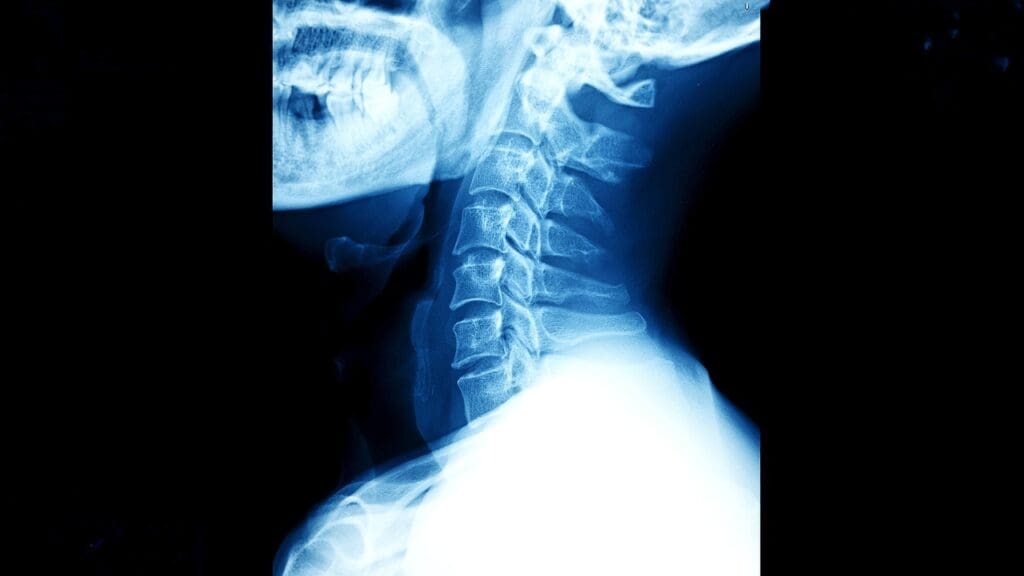 acdf spine fusion