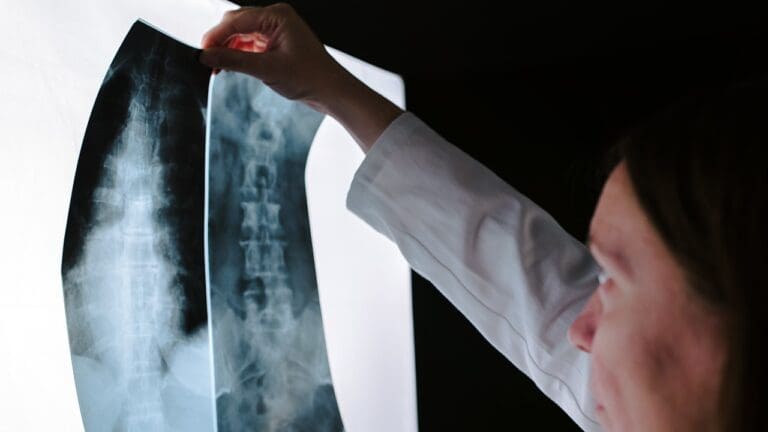 7 Key Facts About ACDF Spine Fusion: What to Know Before Surgery