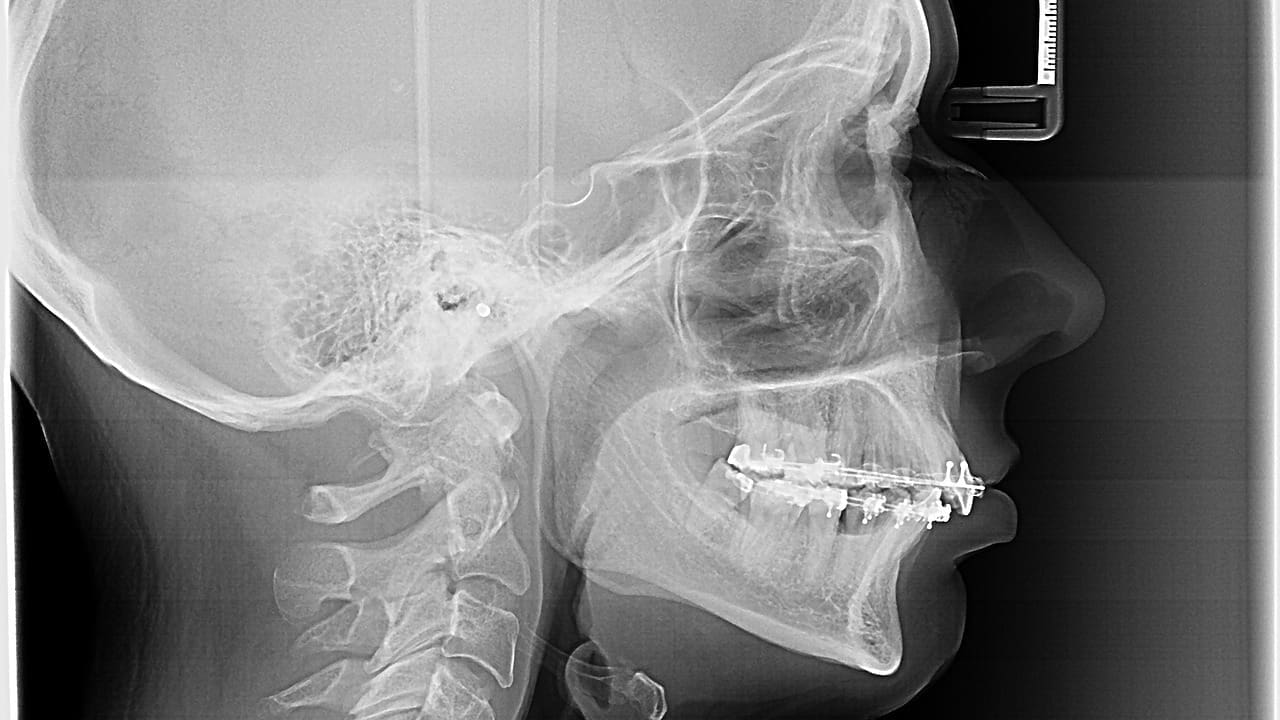 ACDF Surgery: 7 Key Facts About Anterior Cervical Discectomy & FusionAnterior Cervical Discectomy & Fusion