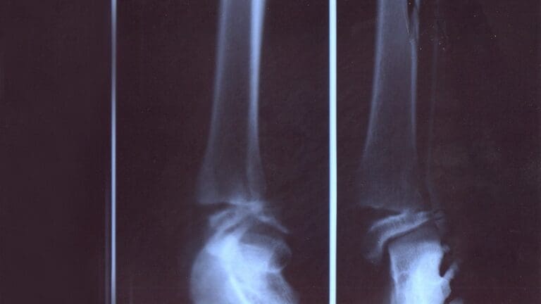 4 Stages of Slip Disc: Causes and Symptoms Explained