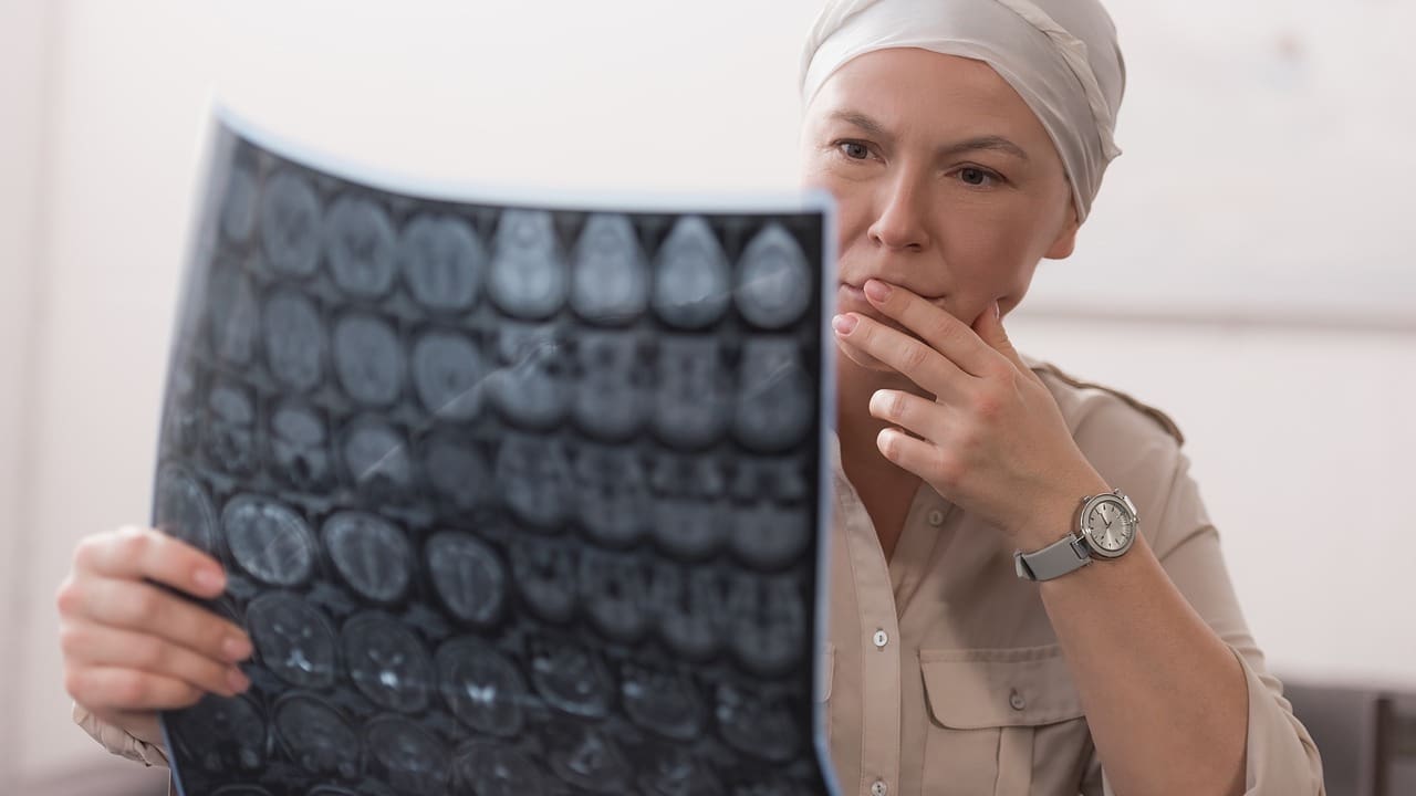 Quality of Life After Brain Tumor Surgery: 7 Vital Survival and Recovery Facts