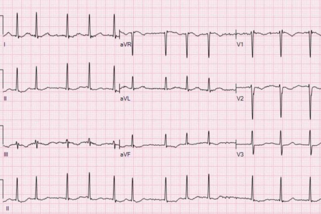 Atrial Fib Ablation: Does It Cure AFib?
