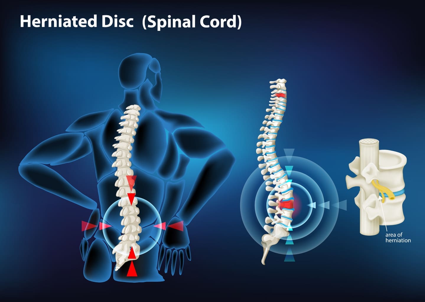 How Can a Slipped or Herniated Disc Cause Hip Pain and What Are the Best Treatments?