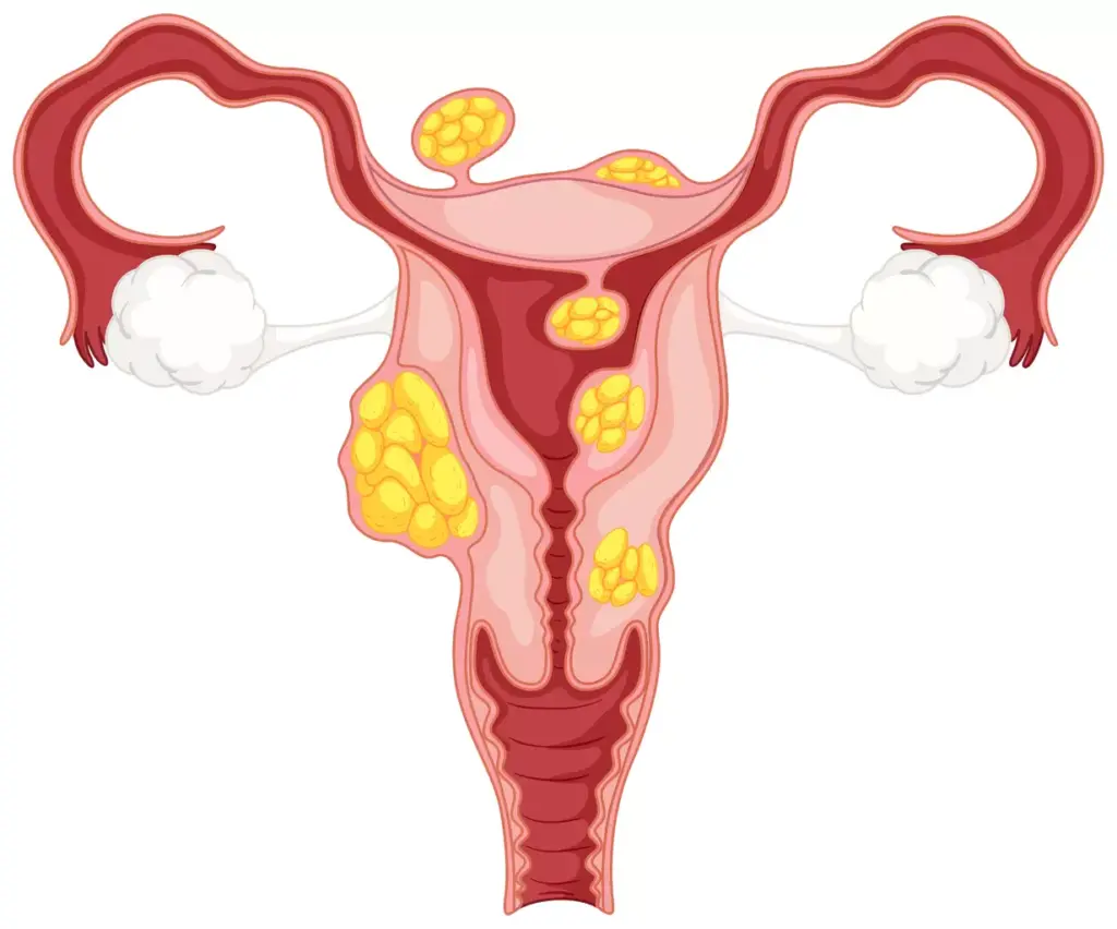 A detailed 3D illustration of a woman's uterus, prominently showcasing a cluster of uterine fibroids. The fibroids should be rendered with a realistic, textured appearance, accurately reflecting their fleshy, bulbous nature. The uterus should be depicted in a neutral, cross-sectional view, allowing the viewer to clearly see the fibroids occupying the uterine cavity. Soft, diffused lighting should create a clean, educational atmosphere, while a shallow depth of field ensures the fibroids are the focal point. The overall image should convey a sense of clinical importance, highlighting the impact these growths can have on a woman's reproductive health.