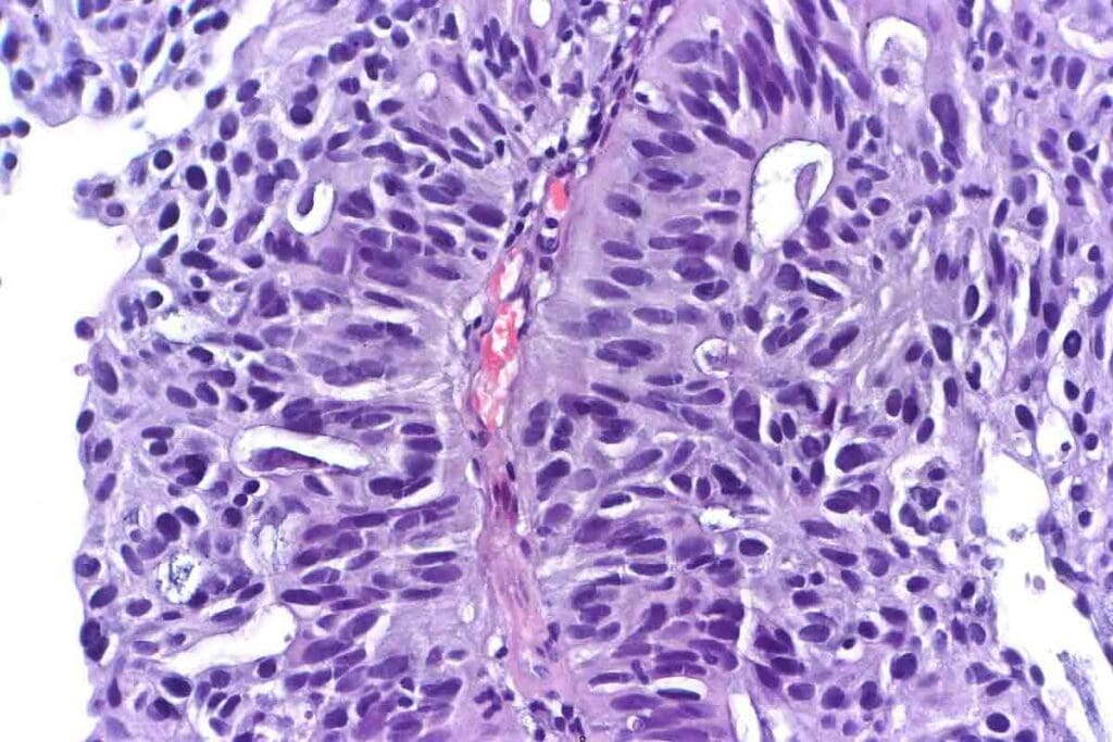 Arms Cancer: Symptoms and Treatment for Alveolar Rhabdomyosarcoma