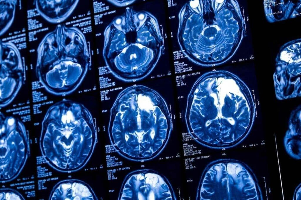 How Do Brain Tumors Develop? Key Causes and Common Risks