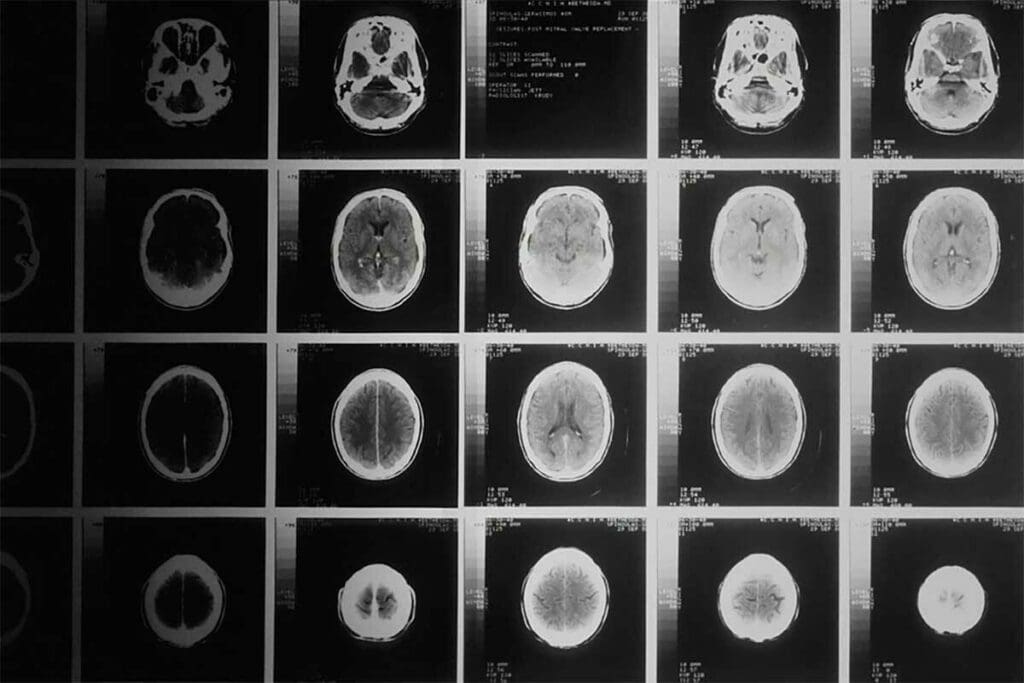 How Do Brain Tumors Develop? Key Causes and Common Risks