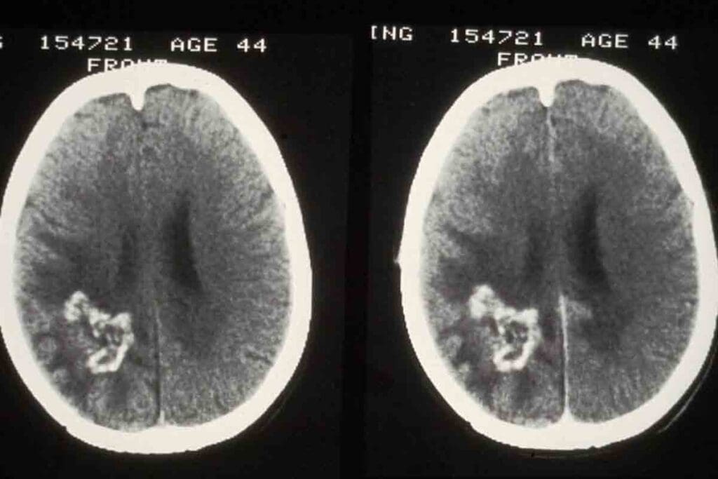 Average Age for Brain Tumor: 8 Key Facts and Survival Data 1 Average Age for Brain Tumor: 8 Key Facts and Survival Data