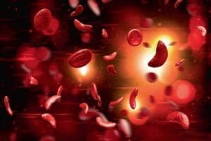 Can White People Get Sickle Cell Anemia? Key Insights