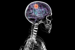 Causes of Brain Tumors in Teenagers: 7 Early Warning Signs