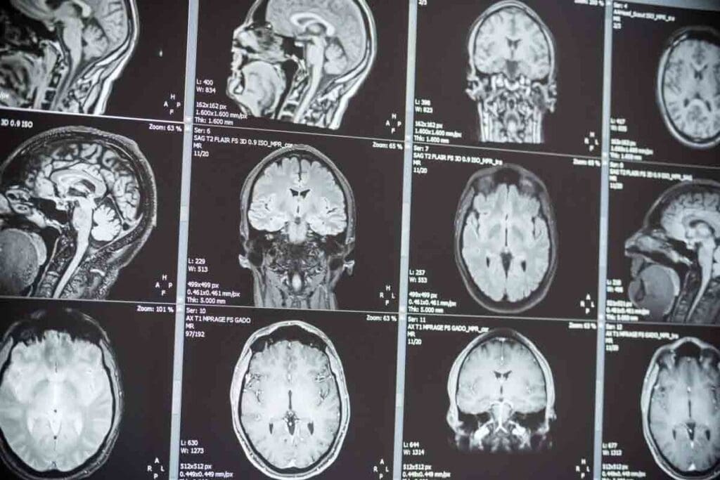 Brain Tumor Age Group: 13 Key Survival and Prevalence Facts 2 Brain Tumor Age Group: 13 Key Survival and Prevalence Facts