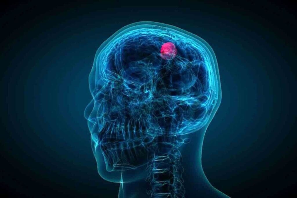 Brain Tumor Age Group: 13 Key Survival and Prevalence Facts 1 Brain Tumor Age Group: 13 Key Survival and Prevalence Facts