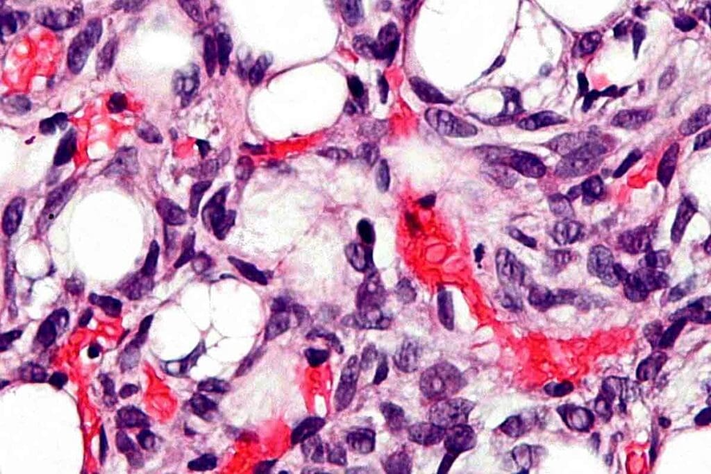 Iron Deficiency Anemia Pediatrics: 12 Key Facts (2025 Guide)